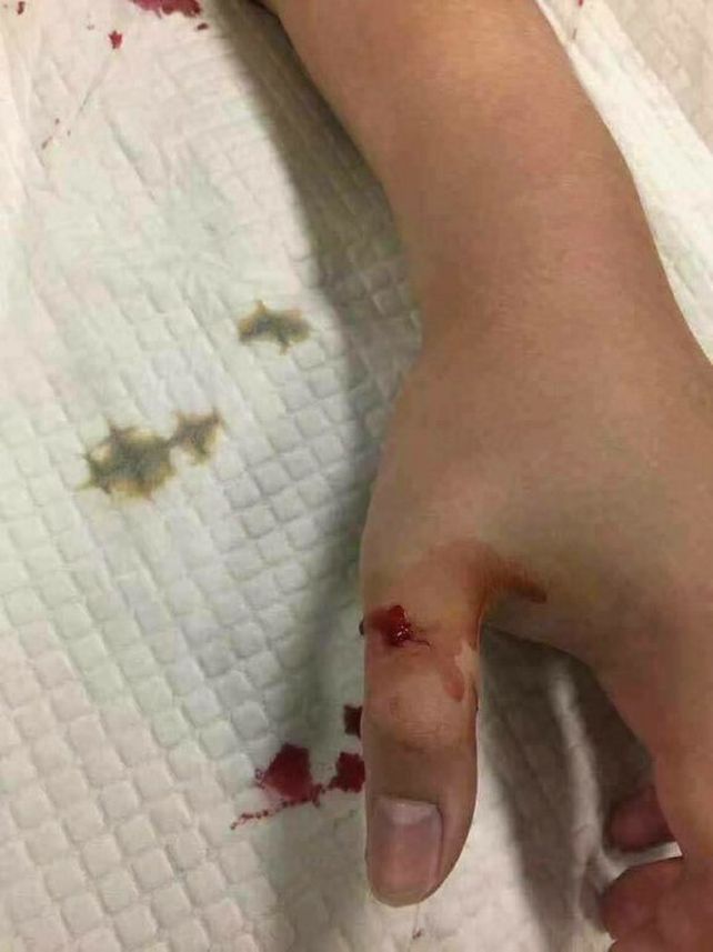 Esto pasa si no tratás a tiempo una mordedura de serpiente venenosa