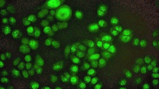 Células. De cáncer de mama triple negativo expresando la proteína Foxp3 después del tratamiento con quimioterapia.