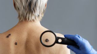 Villa Elisa: campaña de prevención del cáncer de piel