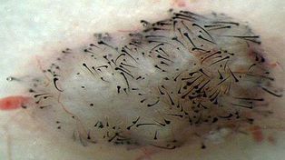 Hallan una fuente infinita de células madre humanas que curan la calvicie