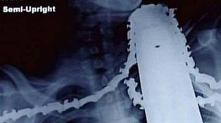 Se incrustó una motosierra en el cuello y sobrevivió