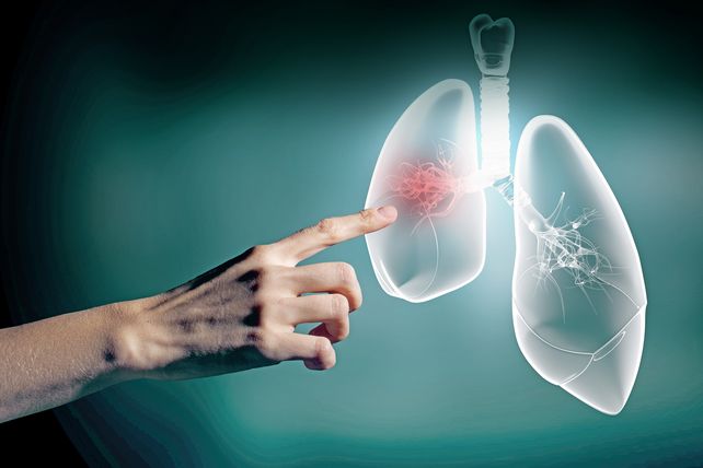 Campaña para detección temprana del cáncer de pulmón.