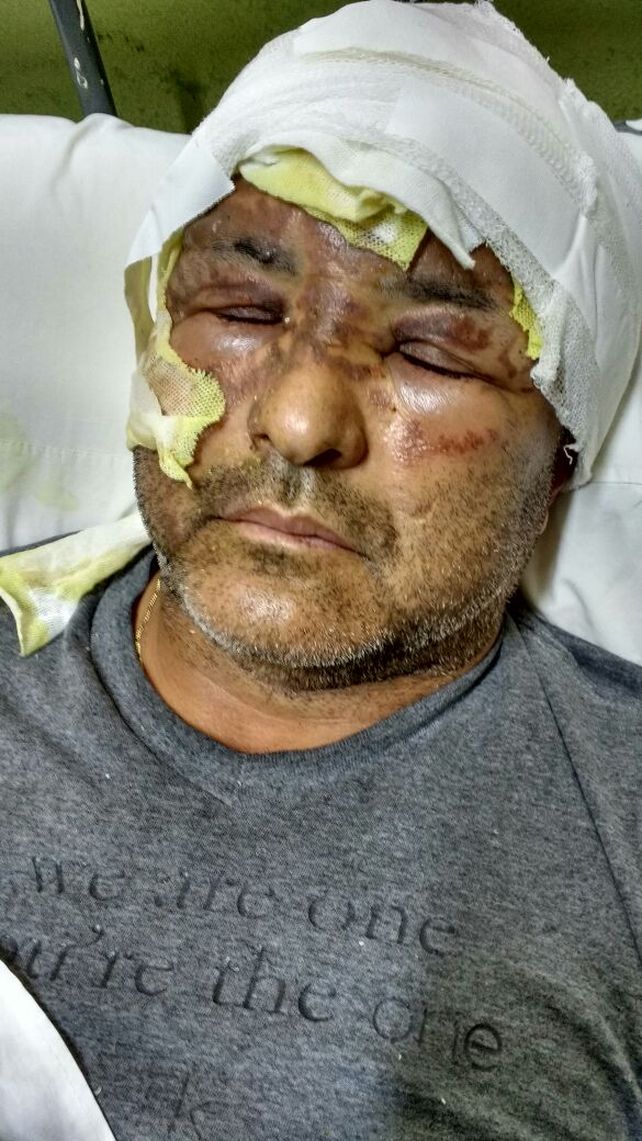 Secuelas. El Policía sufrió quemaduras leves en gran parte del rostro.