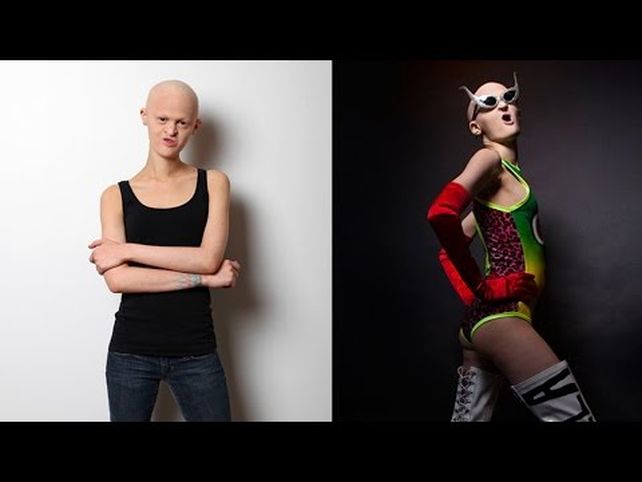 Conocé a la modelo internacional con una mutación genética única