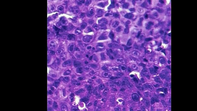 Cáncer de mama: exploran nuevas terapias para triple negativo