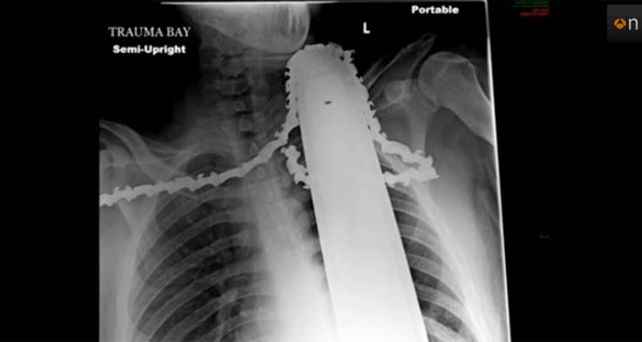 Salvó su vida tras incrustarse una motosierra en el cuello