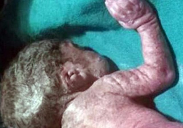 Conmoción por el nacimiento de un “bebe sirena”