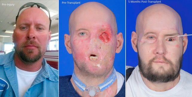 Hito médico: lograron trasplantar un ojo completo a un paciente en EEUU