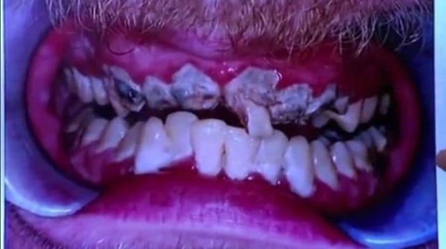 Mostró sus dientes luego de 20 años sin lavárselos