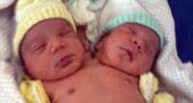 Una mujer dio a luz a un beb&eacute; con dos cabezas en Brasil