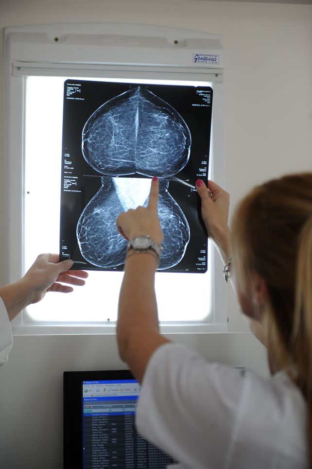 La mamografía es una exploración diagnóstica de imagen por rayos X de la glándula mamaria. Una práctica clave en la prevención.