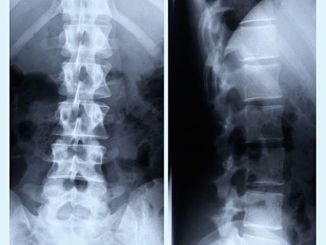 Qué es y cuánto tiempo de recuperación conlleva una  fractura en la tercera vértebra lumbar