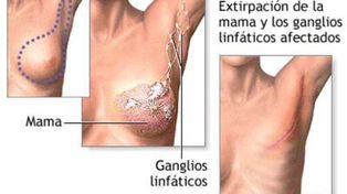Mastectomía, una alternativa más para prevenir el cáncer de mama hereditario