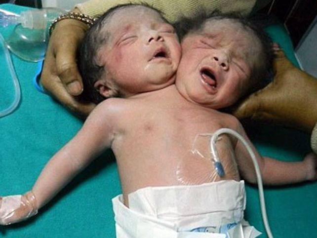 Murieron las siamesas que nacieron con dos cabezas y un solo cuerpo en Bangladesh