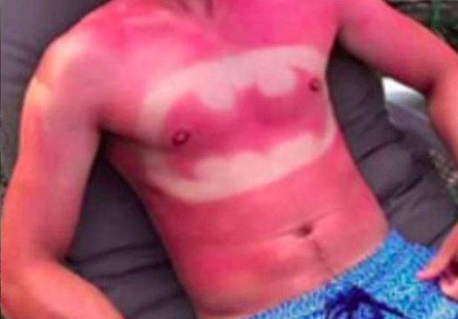 Una moda juvenil de tatuarse con el sol preocupa a los especialistas de la piel