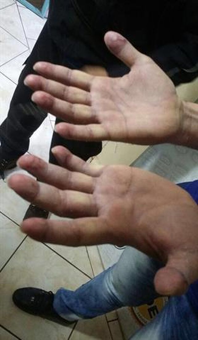 Así están las manos de Ibar Pérez Corradi: habría intentado borrarse las huellas digitales