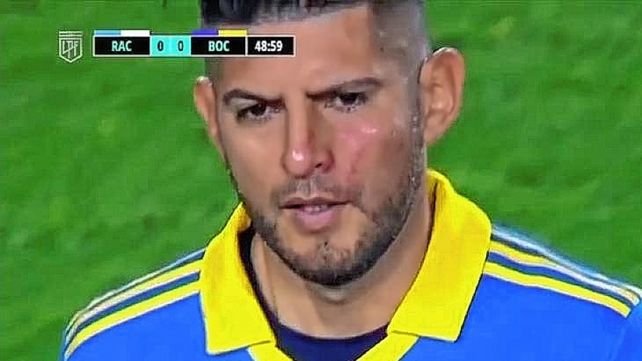 Carlos Zambrano tenía un visible golpe cerca de su ojo.