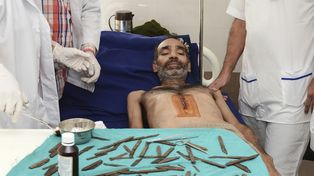 Fue al médico por un fuerte dolor abdominal y lo operaron para sacarle 40 navajas de la panza