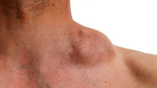 Se debe consultar al médico si se nota un aumento de los ganglios en cuello.