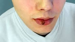 Se disparan los casos de sífilis en Rosario: cómo se contagia la enfermedad