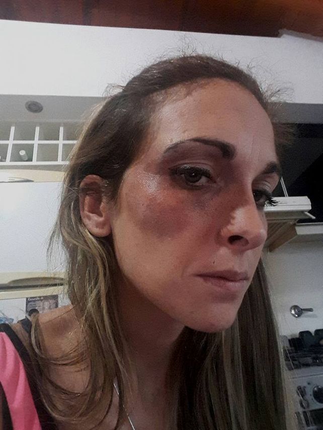 Rastros de la golpiza. Así le quedó el pómulo derecho a la madre atacada a golpes. (Foto de Facebook)