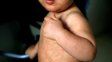 Alerta sanitaria por casos de sarampión Alerta sanitaria por casos de sarampión