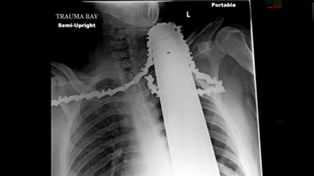 Salvó su vida tras incrustarse una motosierra en el cuello