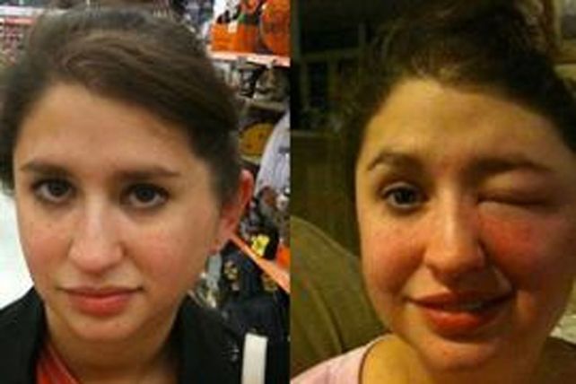 Insólito: una joven fue picada por una peligrosa araña y casi queda ciega