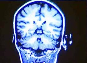 La p&eacute;rdida de la capacidad cognitiva puede comenzar a los 45 a&ntilde;os