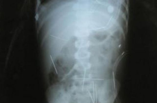 Intentar&aacute;n operar en Brasil a un chico para extraerle 50 agujas de su cuerpo