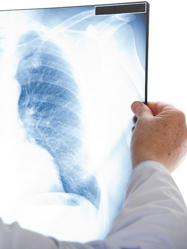 Nódulo pulmonar: qué significa encontrarlo en una tomografía y cuándo puede ser cáncer