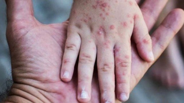 Sarampión: Epidemiología descartó el caso sospechoso de Villa del Rosario