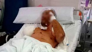 Tucumán: entró a robar una casa, lo atacó un Pitbull y perdió un brazo