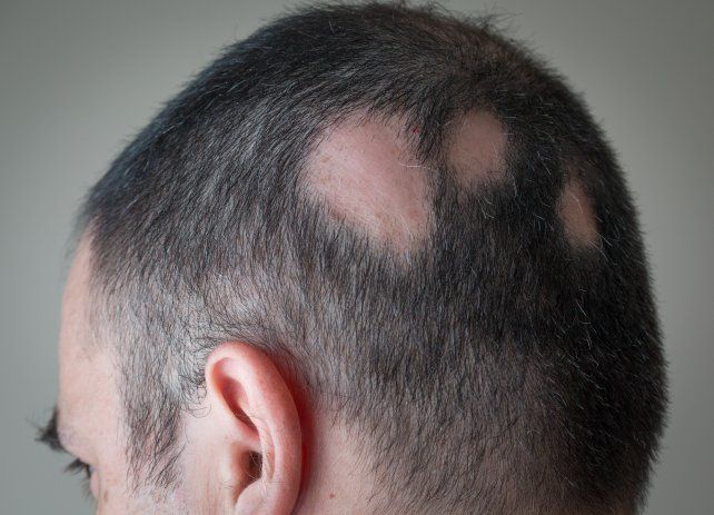 Un caso típico de alopecia areata