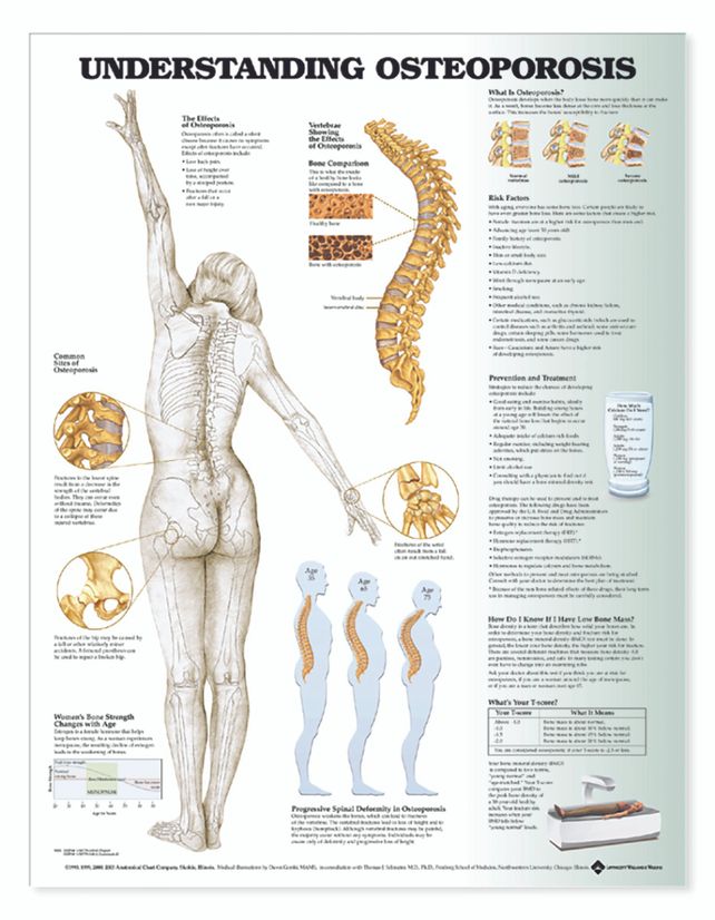 La osteoporosis también es una cuestión de hombres