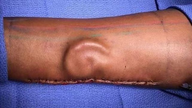 A una soldado le creció la oreja en un brazo