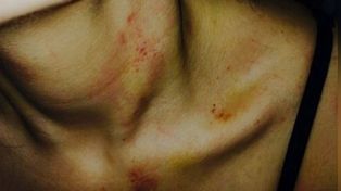 La joven mostró las marcas que le quedaron después de la agresión.&nbsp;
