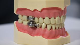 Polémico método contra la obesidad: crean un candado para bloquear la dentadura