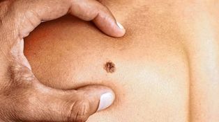 Cáncer de piel: la importancia de revisar los lunares