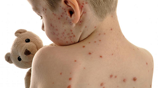 Emitieron un alerta por la aparición del virus del sarampión
