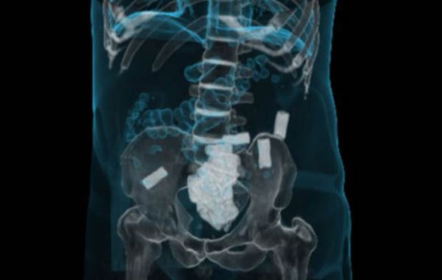 Placa. Una imagen de tomografía ilustra donde llevan la droga las mulas.