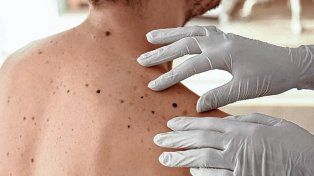 La importancia de la prevención en el cáncer de piel