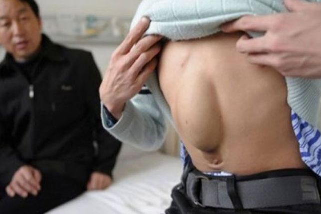 Vivió 24 años con el corazón en el abdomen