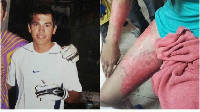 Un boxeador roció con nafta y prendió fuego a su novia