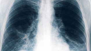Neumonía bilateral por legionella: crecen los casos en Tucumán. Hay ocho nuevos casos y son seis los decesos.&nbsp;