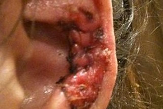 Insólito: una joven fue picada por una peligrosa araña y casi queda ciega