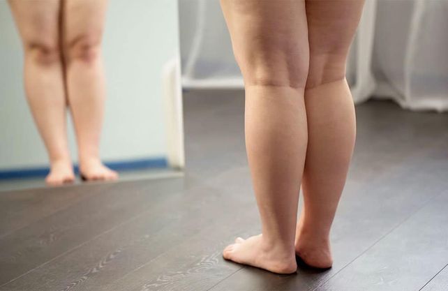 El lipedema causa inflamación