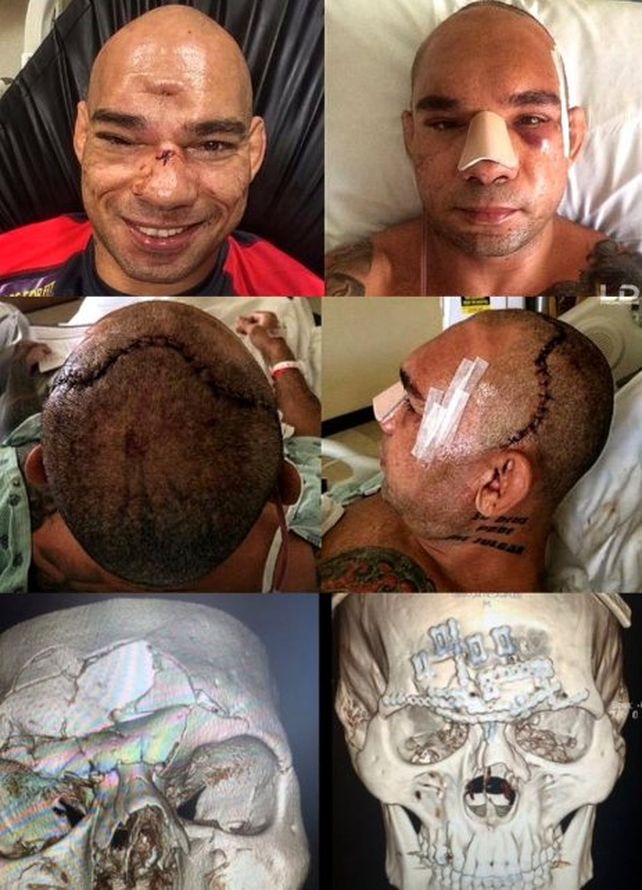 Así le quedó el cráneo al luchador que había sufrido una fractura en un combate