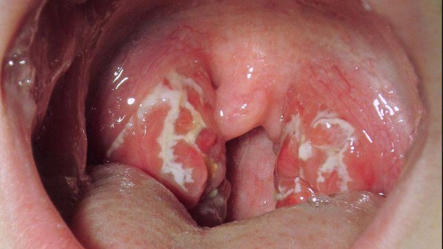 El ministerio de Salud de la Nación notificó 118 casos de infección invasiva por streptococcus pyogenes en el país y 16 fallecidos. Qué es y cómo se contagia&nbsp;
