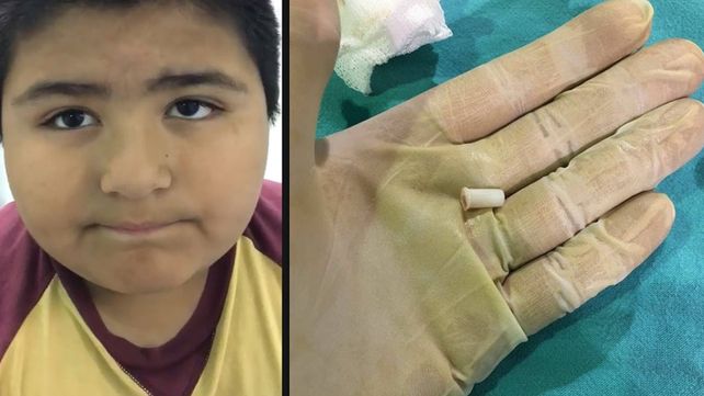 Un nene se tragó un silbato y se hizo viral en las redes